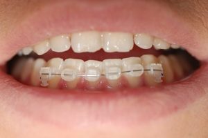 braces partial lower brackets dental underwood month