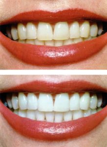 Teeth whitening comparison.