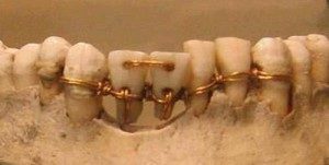 Ancient-orthodontics