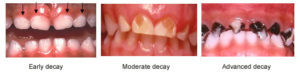 decay teeth severity