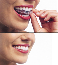 Invisalign - the clear alternative to braces.