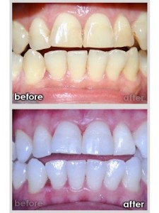 Bleaching before and after image