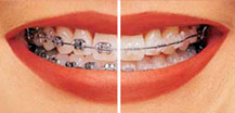 3M Unitek metal braces vs 3M Unitek clear braces image.