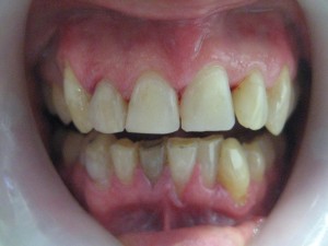 with composite resin restore his incisal edges