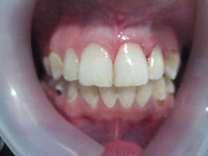 resin fixing black spots on teeth