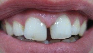 Teeth with gap