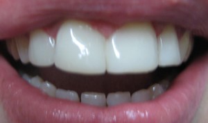 composite resin for gap teeth