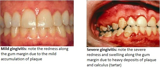 gingivitis1