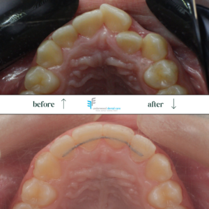 View of bottom row of teeth showing teeth before and after braces treatment