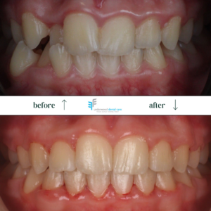 Teeth viewed from front with top of image showing before braces and bottom of image showing after braces