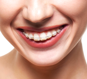 Smiling face of woman with ceramic braces