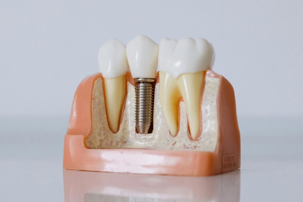 Dental implant demonstration model showing how implant acts as tooth root